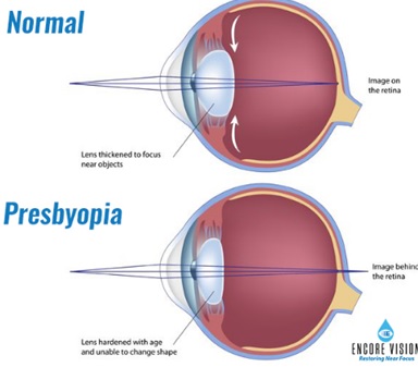 Mobile Phones Causing Presbyopia At An Early Age: Doctors