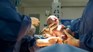 C-Section,Obesity,cesarean